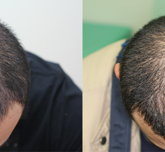 AGA 薬 治療前と後（5か月）30代男性／病院