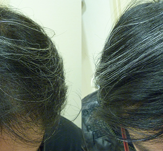 AGA 薬 治療前と後（6か月）30代男性／病院