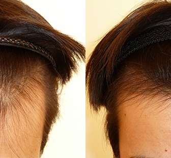 AGA 薬 治療前と後（5か月）30代男性／病院