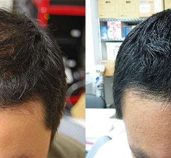 AGA 薬 治療前と後（3か月）30代男性／病院