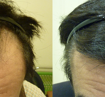 AGA 薬 治療前と後（6か月）50代男性／病院