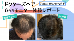 AGA発毛治療モニターレポート Case01:男性・60代前半